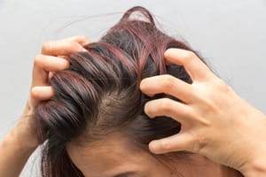 Why Your Scalp is So Itchy: The Seborrheic Dermatitis Story